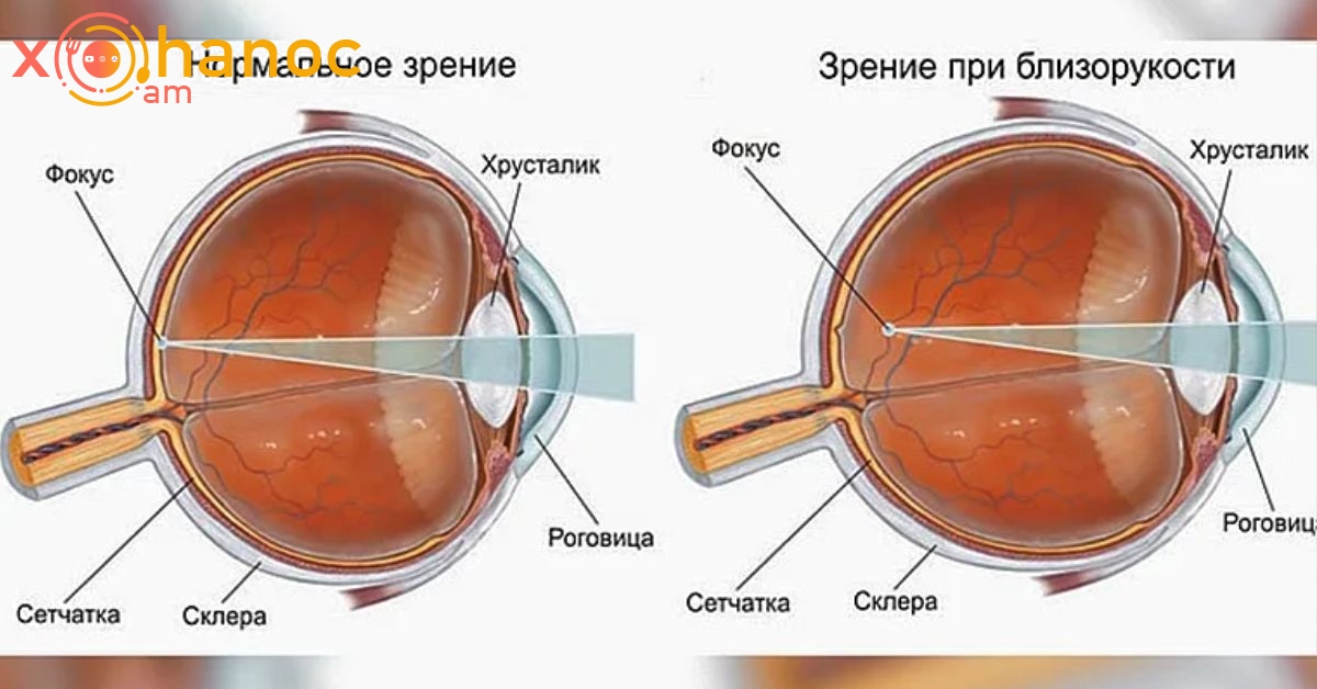 Որ սովորությունները կարող են փչացնել ձեր տեսողությունը. բժիշկը բացատրում է