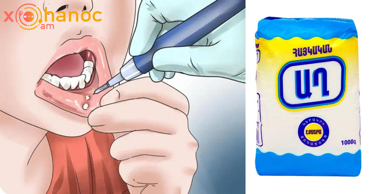 Սովորական աղի միջոցով ազատվեք ստոմատիտից․ Ահա թե ինչպես Սովորական աղի միջոցով ազատվեք ստոմատիտից․ Ահա թե ինչպես