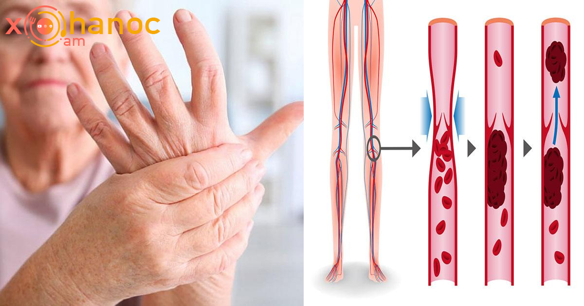 Ինչպես ազատվել ձեռքերի և ոտքերի թմրածությունից