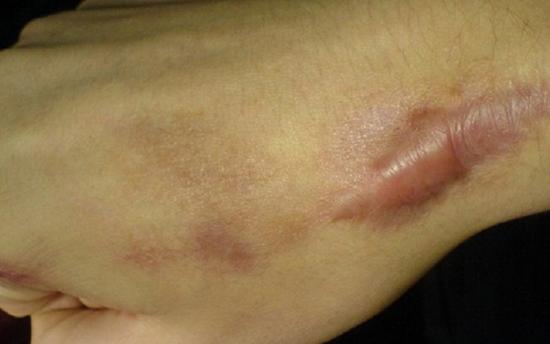 Սպիները վերացնելու մի քանի բնական միջոցներ