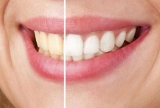 Ինչպես սպիտակեցնել ատամները բնական ճանապարհով