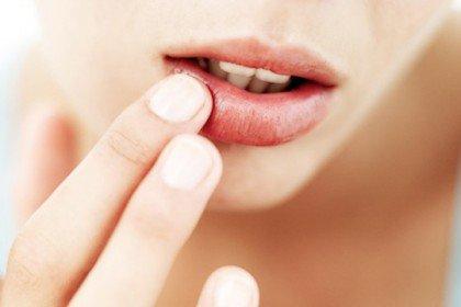 Ինչպես արագ բուժել հերպեսը