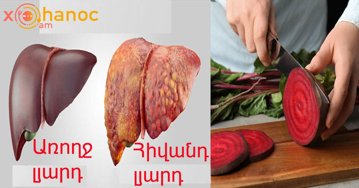 Բազուկը փոշեկուլի պես կմաքրի լյարդը․ Միայն այսպես օգտագործեք Բազուկը փոշեկուլի պես կմաքրի լյարդը․ Միայն այսպես օգտագործեք