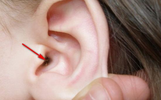 Ականջների խցանումից ազատվելն ընդհանրապես դժվար չէ. փորձեք այս բաղադրատոմսը