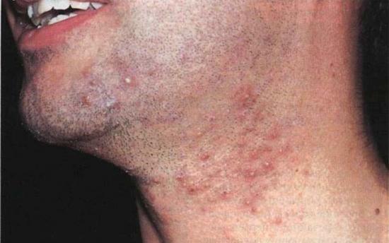 Ինչպե՞ս ազատվել ներաճած մազերից