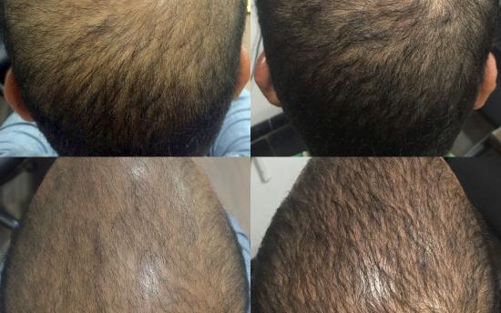 Ինչպե՞ս վերականգնել թափված մազերը