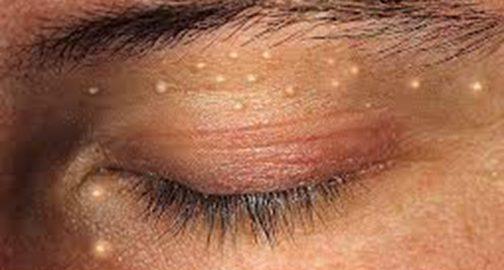 Ինչպես ազատվել ճարպագնդերից