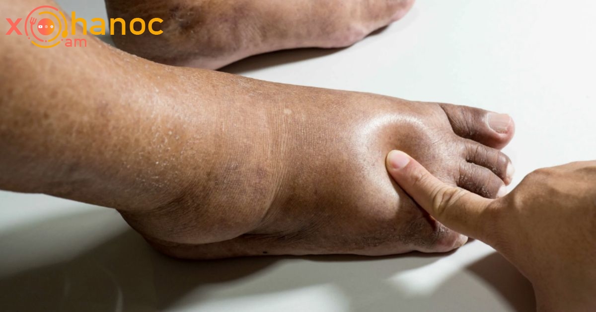 Եթե ​​ձեր ձախ ոտքը պարբերաբար այտուցվում է, սա մի քանի հիվանդությունների ախտանիշ է