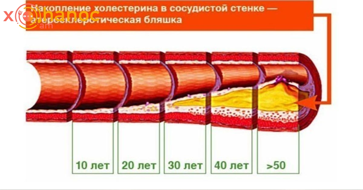 Օրական ընդամենը 1 բաժակ այս ըմպելիքը կօգնի մաքրել անոթները խոլեստերինից