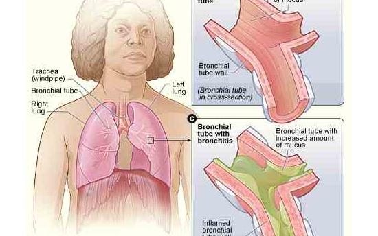 Մաքրեք թոքերը խեժից, նիկոտինից և կանխեք քաղցկեղն այս պարզ միջոցով