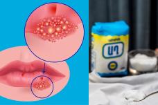 Աղի միջոցով ազատվեք հերպեսից հաշված ժամերի ընթացքում