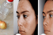 Սովորական սոխի և քացախի միջոցով մաշկը մաքրեք այս հետքերից