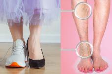 Այս գործոնը նպաստում է վարիկոզին․ Մի արեք այսպես