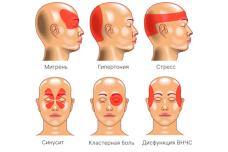 Ասեք գլխի որ հատվածում ցավ ունեք և իմացեք ինչ հիվանդության պատճառով է ցավը