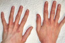 Մաշկի քաղցկեղի աաջին նշանը կարող եք հասկանալ նայելով ձեռքերին և մատներին