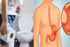 Սա ստամոքսի խոցի ախտանիշ է. Ճանաչեք խոցը վաղ փուլերում