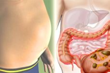 Ինչու՞ են աղիները փքվում և ինչպես ազատվել այդ խնդրից