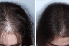 Ինչպե՞ս ազատվել մազաթափությունից. Այսպես խնամեք ձեր մազերը և չեք ունենա ոչ մի խնդիր