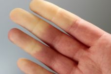 Ի՞նչ լուրջ հիվանդություն է սա և ովքե՞ր պետք է զգուշանան այս ծանր հիվանդությունից