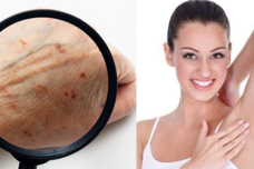 Ի՞նչ հիվանդության մասին է վկայում թևատակի քորը