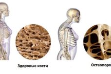 Այն կանխում է ոսկրերի կորուստը և օստեոպորոզը, ինչը հատկապես կարևոր է 50 տարեկանից բարձր կանանց համար