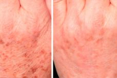 Բնական դեղամիջոց ՝ պիգմենտային կետերից ազատվելու համար. Անհավանական արդյունք Բնական դեղամիջոց ՝ պիգմենտային կետերից ազատվելու համար. Անհավանական արդյունք