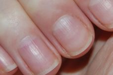 Ինչու՞ են այսպիսի գծեր հայտնվում եղունգների վրա․ Բժշկի պատասխանը