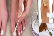 Այս ժողովրդական միջոցը վերացնում է եղունգների սունկը