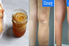 Սոխը ընդդեմ երակների վարիկոզի․ Կիսվում եմ իմ գաղտնիքով