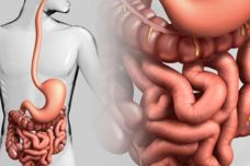 Բնական բաղադրատոմս՝ աղիները մաքրելու համար. Պահպանեք բաղադրատոմսը և կիրառեք