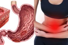 Ի՞նչ ուտել և խմել, որպեսզի վերանա ստամոքսի ցավը, նույնիսկ ստամոքսի խոցը