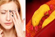 3 նշան որոնք վկայում են խոլեստերինի բարձր մակարդակ ունեք