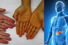Քաղցկեղի առաջին նշանը, որը կարող ենք հասկանալ ձեռքի ափից