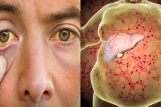 Ուշադրություն․ Սա լյարդի ճարպակալման նշան է, երբեք աչքաթող չանեք և շտապ դիմեք բժշկի