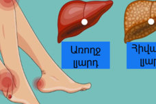 Լյարդի հիվանդության նշան է սա․ Մի անտեսեք, քանի որ լյարդը չի ցավում, բայց քայքայվում է