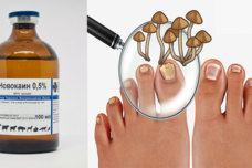 Այս միջոցը 2 անգամ օգտագործեք և վերջնականապես կազատվեք սնկից․ Այն մաշկաբանն է նշանակել