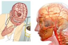 Ուղեղում արյան շրջանառությունը բարելավելու 3 ամենահզոր բաղադրատոմսերը