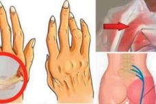 Ինչպես ազատվել արթրիտից, մեջքի ցավից և նստատեղի ցավից