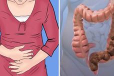 Աղիները մաքրող բնական բաղադրատոմս․ Հենց աղիների պատճառով է առաջանում փորկապություն, շաքարախտ կամ այլ հիվանդություն