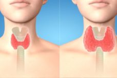 Ինչպես տան պայմաններում բուժել վահանաձև գեղձը