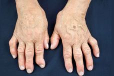 Դիետոլոգը խորհուրդ է տալիս մթերքներ, որոնք թեթևացնում են արթրիտի ախտանիշները