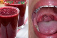 Բուժեք ամենածանր անգինան և կոկորդի բորբոքումները ընդամենը մեկ օրում