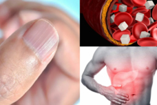 Այսպիսի եղունգները վկայում են լյարդի հիվանդության և շաքարային դիաբետի մասին