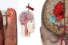 Ինսուլտի ժամանակ ասեղը կարող է փրկել հիվանդի կյանքը. Այս խորհուրդը գանձ է, կարդացեք և պահպանեք