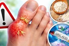 Ինչպես վերացնել ոտքի վրա աճած ոսկորը և նվազեցնել միզաթթուն