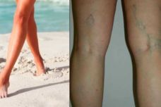 Ինձ շատ էր տանջում երակների վարիկոզ լայնացումը, մինչև որ իմացա այս միջոցի մասին․ Այժմ իմ ոտքերը հիանալի տեսք ունեն և չեն ցավում