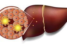 Որոնք են լյարդի ճարպակալման ախտանիշները