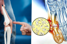 Ինչպես հոդերից հեռացնել աղը և վերացնել միզաթթուն