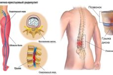 Սխտորի միջոցով ազատվեք մեջքի ստորին հատվածի ցավից Սխտորի միջոցով ազատվեք մեջքի ստորին հատվածի ցավից