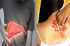 2 թաքնված նշան, որը ցույց է տալիս, որ ձեր լյարդը հիվանդ է